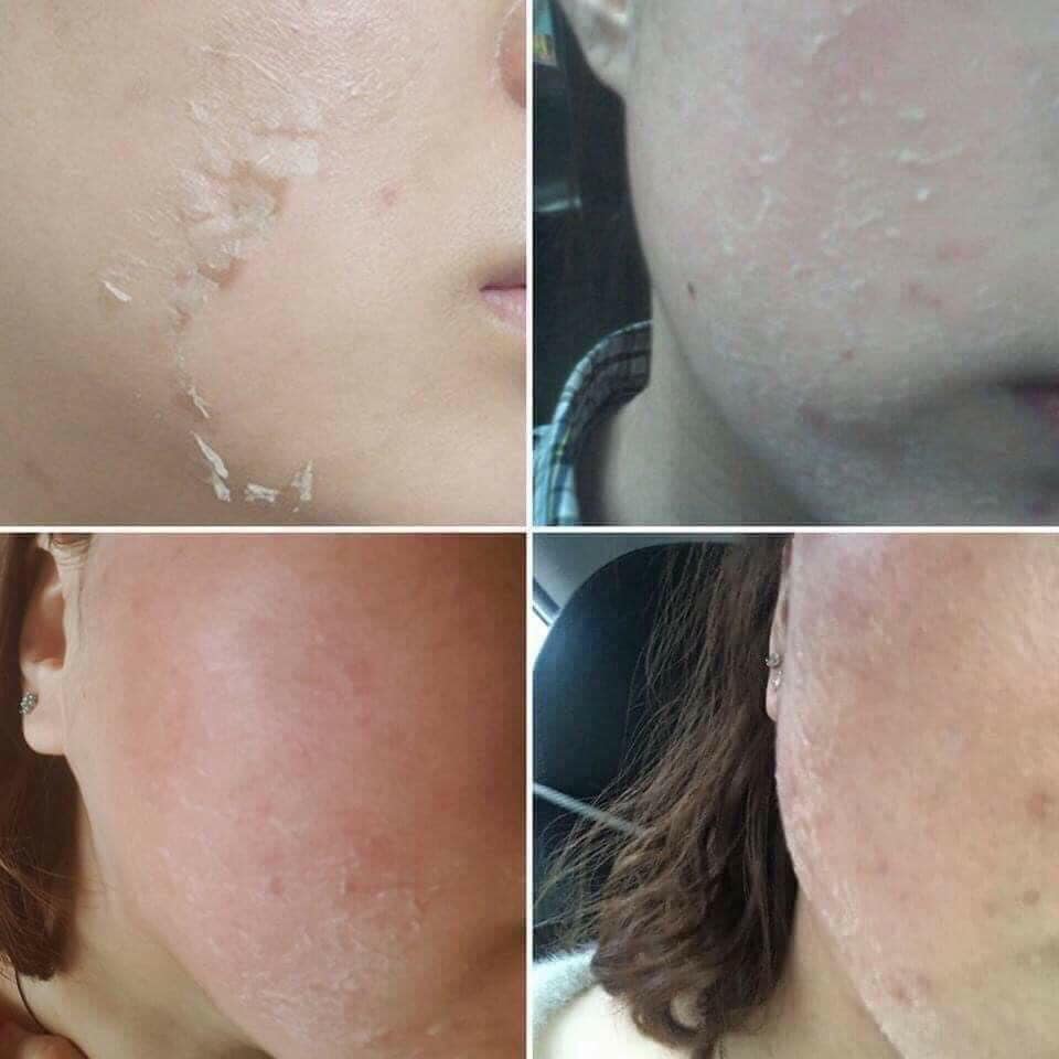 QSCELL 72hr Cell Renewal – Urte Microneedling Kur