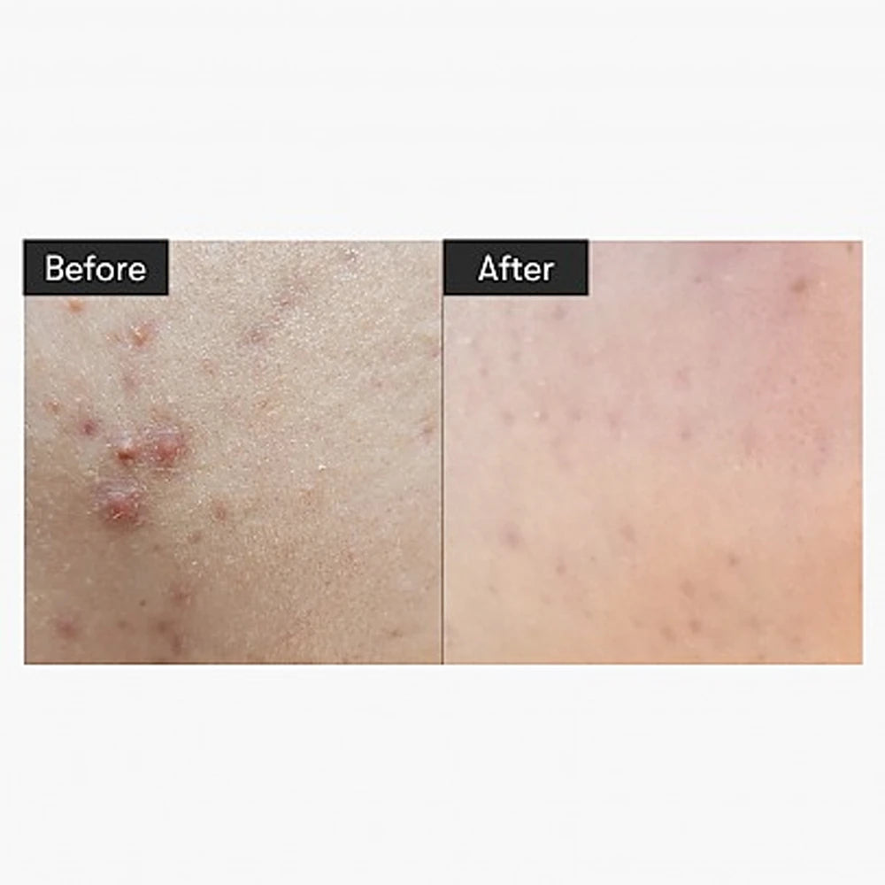 VT - Cica Hyalon Reedle Shot 300